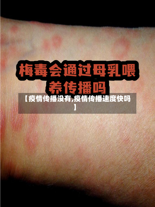 【疫情传播没有,疫情传播速度快吗】-第2张图片